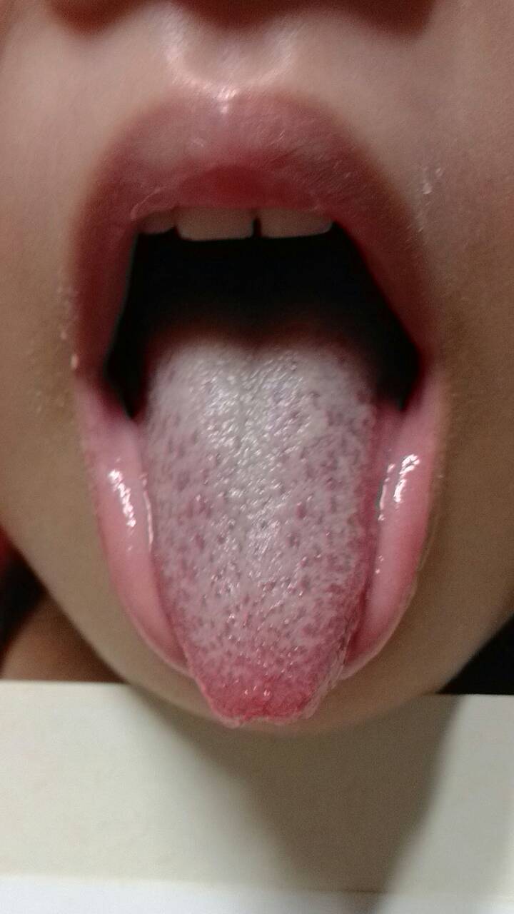 腹膜炎舌象.jpg
